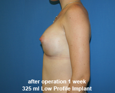 plastic-surgery-breast-augmentation